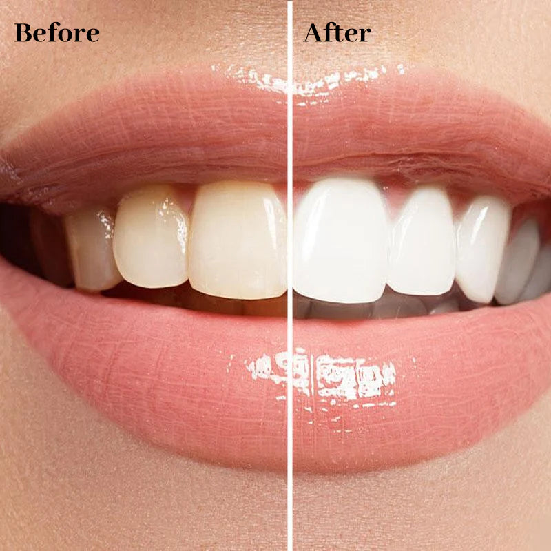 Blizkox™ Whitening Pen