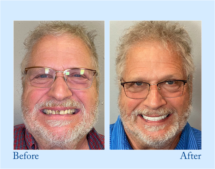 🦷🔥Final 12 Hours: 60%OFF🎁 BBOJI™ Fluoride-Free Hydroxyapatite Toothpaste 💎 Your Smile, Naturally Brighter!
