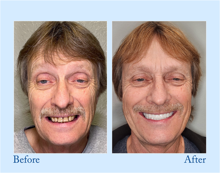 🦷🔥Final 12 Hours: 60%OFF🎁 BBOJI™ Fluoride-Free Hydroxyapatite Toothpaste 💎 Your Smile, Naturally Brighter!