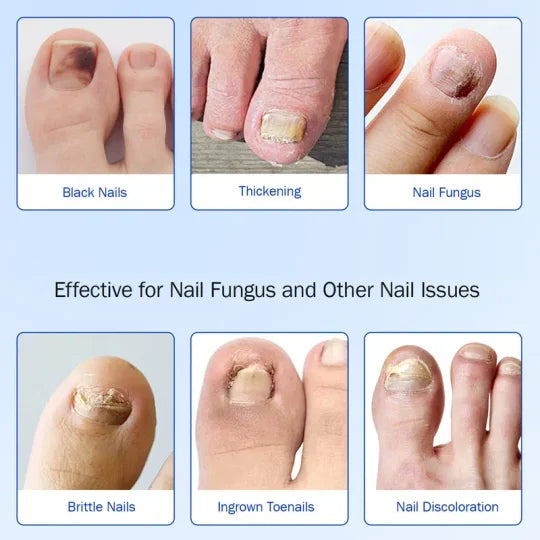 🦶🏻+🩹Restore Healthy Nails with Ease – Fungal Nail Patches