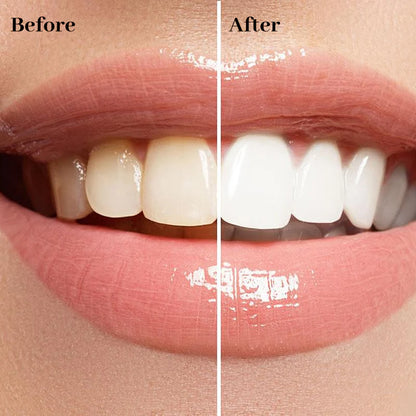 Blizkox™ Whitening Pen